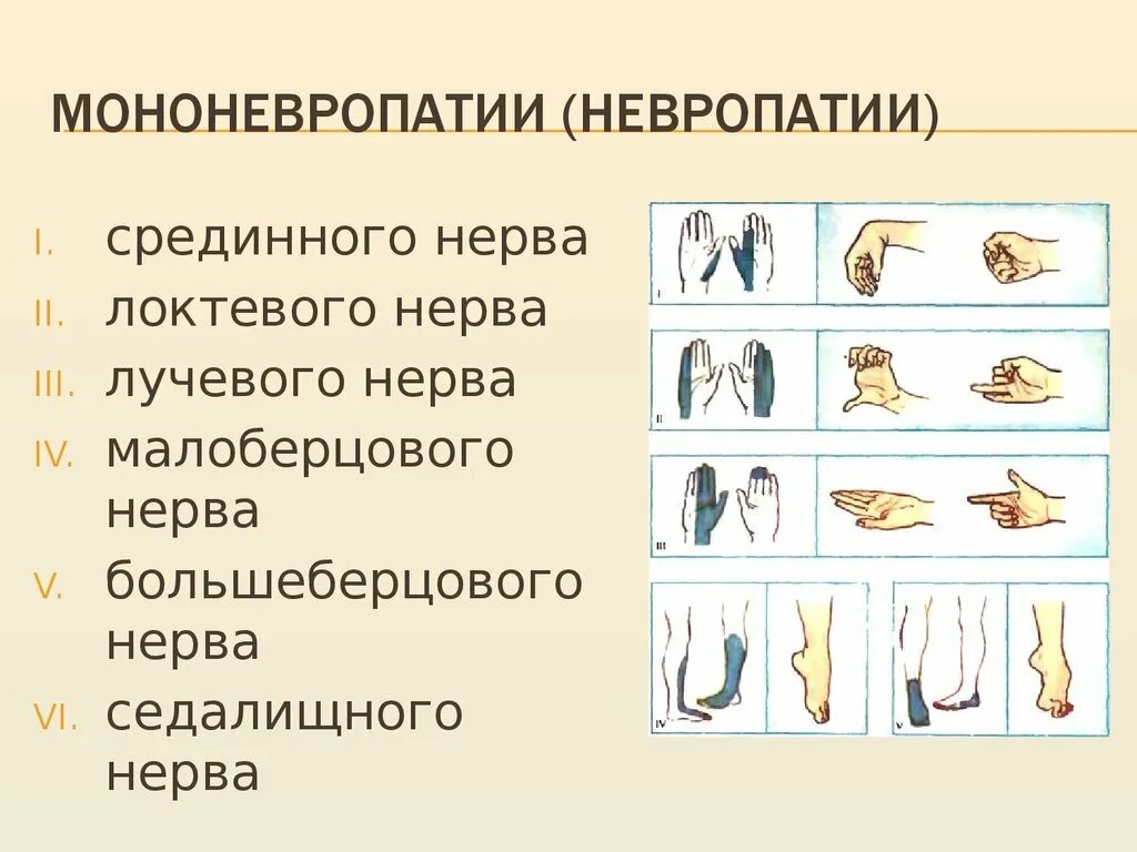 Невропатия нижних конечностей лечение. Невропатия срединного нерва. Мононевропатия. Невротомия срединного нерва. Мононевропатия лучевого нерва.