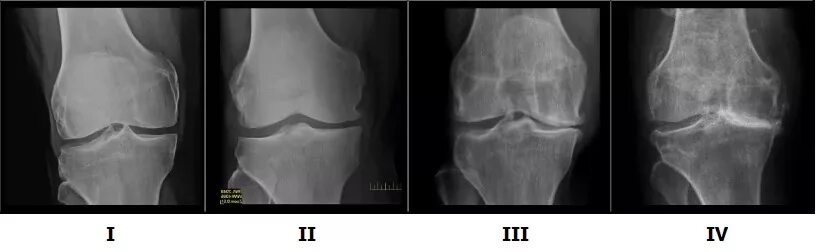 Остеоартроз 1 2 степени коленного сустава. Доа коленного сустава на рентгене. Гонартроз 3 степени коленного сустава рентген. Деформирующий артроз 2 степени. Рентген колена деформирующий остеоартроз.