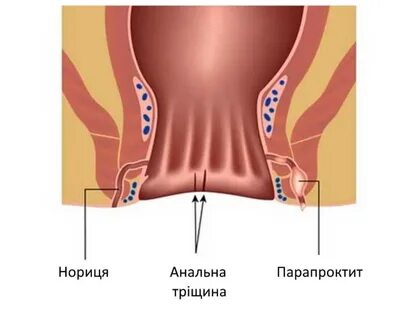 Лікування парапроктиту у Запоріжжі 