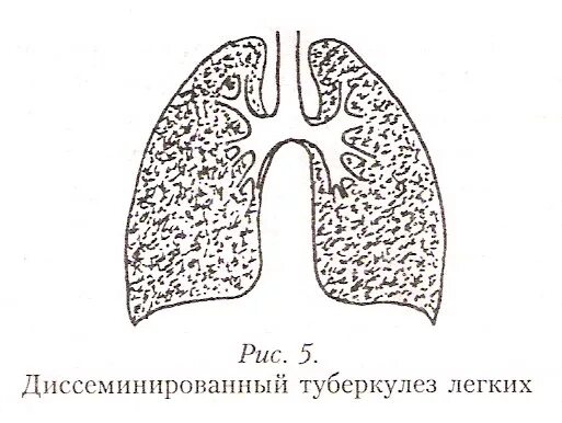 Острый диссеминированный туберкулез. Диссеминированный туберкулез легких схема. Диссеминированный туберкулез легких рисунок. Милиарный туберкулез схема. Милиарный туберкулез легких схема.