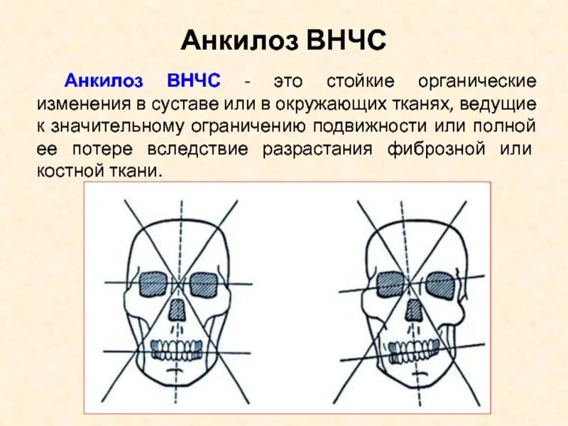 Костный анкилоз ВНЧС рентген. Хирургические методы лечения анкилозов ВНЧС. Аксиографическое исследование ВНЧС. Фиброзный анкилоз височно-нижнечелюстного сустава. Лицевой артрит