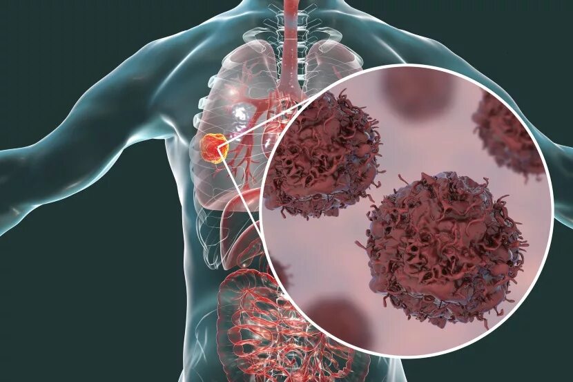 Онкологические заболевания. Опухолевые заболевания. Раковые клетки в организме иллюстрация. Cancer res