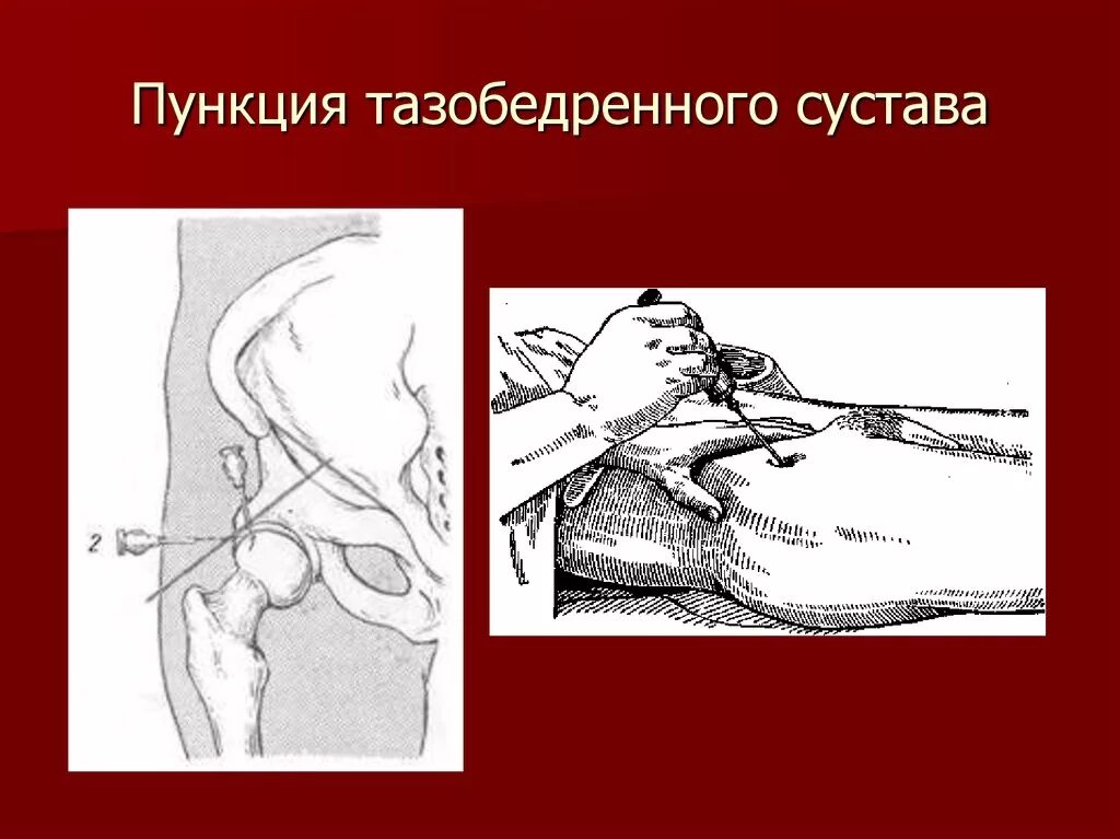 Блокада голеностопного сустава. Точки пункции сустава в тазобедренном суставе. Пункция тазобедренного сустава техника. Методика пункции тазобедренного сустава.