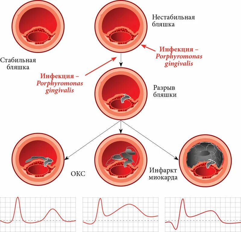 Разрыв атеросклеротической бляшки патогенез. Острый коронарный синдром причины патогенез. Механизмы развития острого коронарного синдрома.