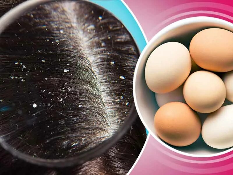 Маска для волос с яйцом. Яйцо от перхоти для волос. Куриное яйцо с волосами. Реклама для стрижки яичек