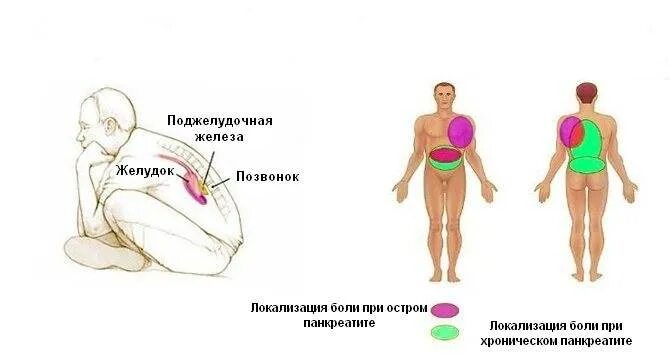 Поджелудочная боль в спине. Острый панкреатит локализация боли. Локализация боли при воспалении поджелудочной железы. Хронический панкреатит локализация боли. Локализация боли при хроническом панкреатите поджелудочной железы.