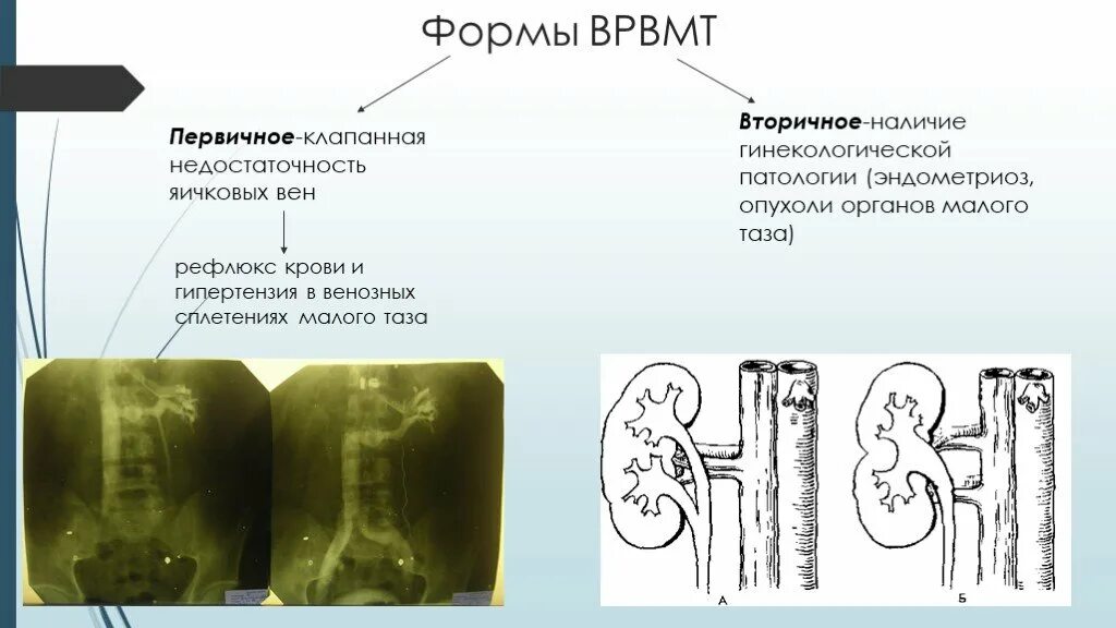 Варикоз органов таза у женщин. Варикозное расширение вен малого таза. Варикозное расширение вен малого таза 2 степени. Варикозное расширение вен малого таза 1 степени. Варикозное расширение вен малого таза 3 степени.