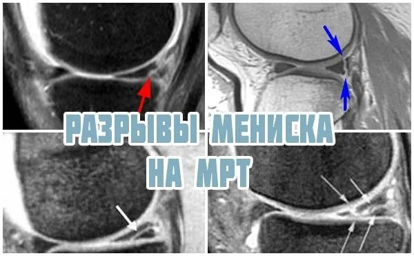 Разрыв мениска рентгеновском снимке. Повреждение мениска коленного сустава мрт. Повреждение корня мениска мрт.