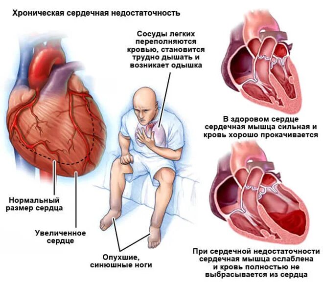 Сердечная недостаточность форум. Клинические проявления хронической сердечной недостаточности. хсн хроническая сердечная недостаточность симптомы. фенотипические проявления острой сердечной недостаточности:. сердечная недостаточно.