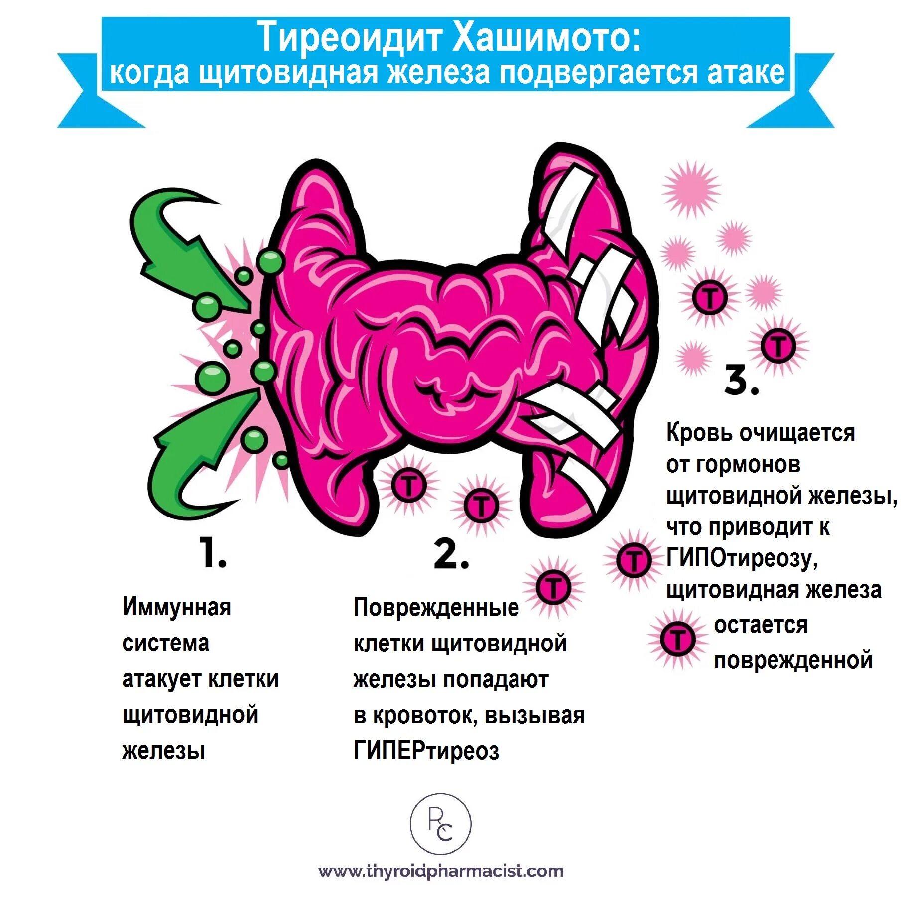 Аутоиммунные изменения щитовидной. Аутоиммунный зоб Хашимото патогенез. Щитовидная железа болезнь Хашимото. Аутоиммунный гипотиреоз патогенез. Хронический аутоиммунный тиреоидит патогенез.