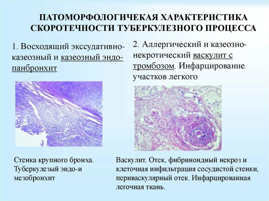 Смешанный периваскулярный инфильтрат при крапивнице