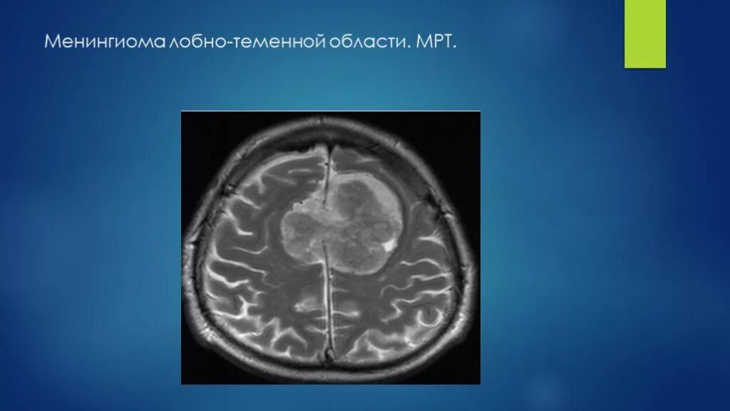 Опухоли теменной. Кальцинированная менингиома на кт. Фалькс-менингиома лобной области на мрт. Интракраниальная менингиома. Менингиома лобно-парасагиттальной области.