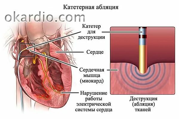 Рча предсердий. Радиочастотная катетерная абляция сердца. Радиочастотная аблация аритмий сердца. Катетерная абляция сердца что это такое.