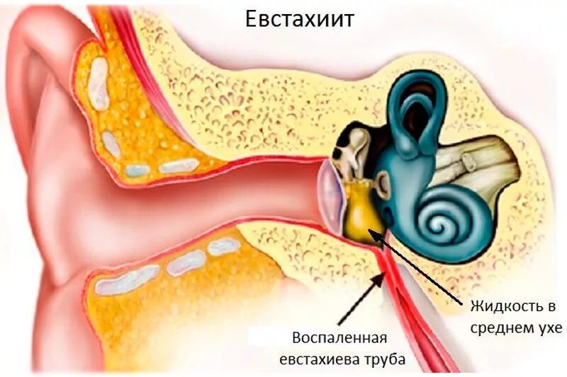 Почему заложенность в ушах. Евстахиева труба воспаление. Воспаление евстахиевой трубки. Тубоотит барабанная перепонка. Евстахиит барабанная перепонка.