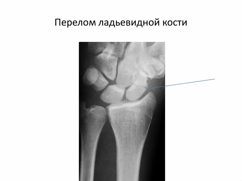 Ладьевидная кость кисти перелом. Ладьевидная кость запястье перелом. Несросшийся перелом ладьевидной кости. Краевой перелом ладьевидной кости.