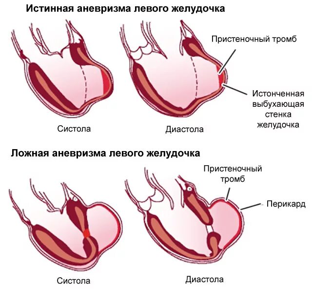 Тромб в желудочке