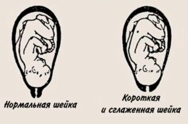 Механизм сглаживания и раскрытия шейки матки. Шейка конической формы. Укорочение шейки матки на 20 неделе беременности. Раскрытие шейки матки 1. Шейка матки стала короче.