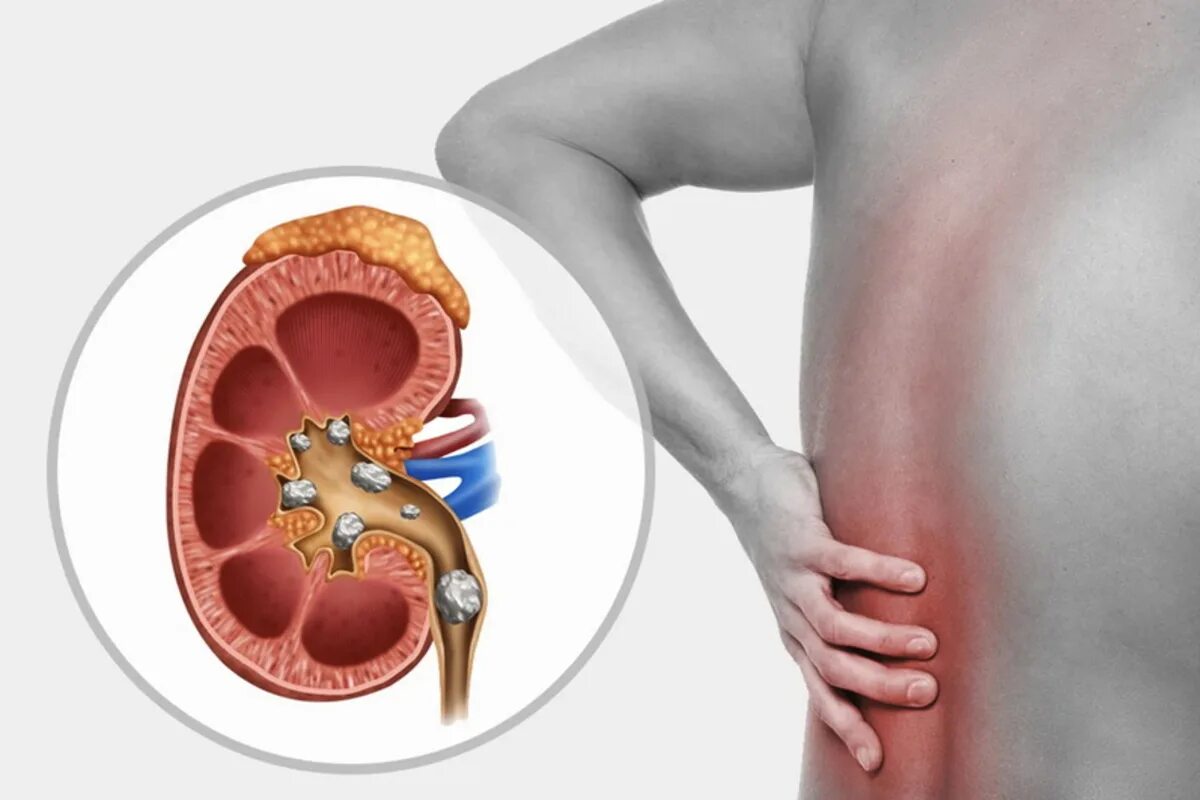 Мочекаменная болезнь конкременты. Мочекаменная болезнь (уролитиаз). Мочекаменная болезнь (urolithiasis). Почечнокаменная болезнь камни. Болит правая почка после