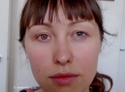 Разные глаза диагноз