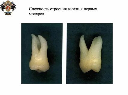 Каналы верхнего моляра