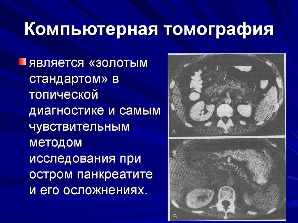 Острый панкреатит метод исследования. Инструментальные исследования острого панкреатита. Острый деструктивный панкреатит кт. Компьютерная томография при остром панкреатите. Обследования при панкреатите