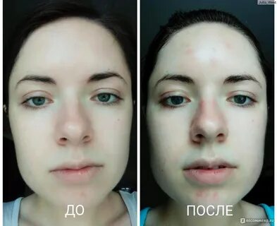 Что можно делать после чистки