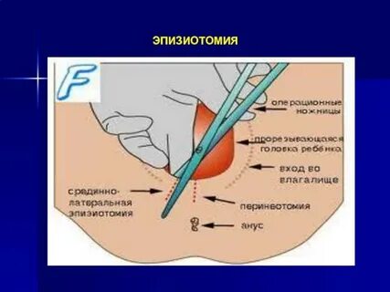 Швы при родах