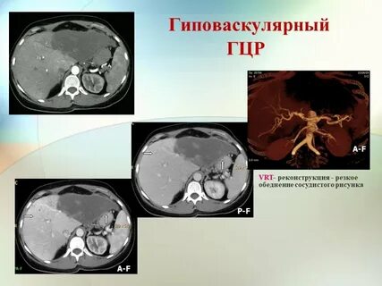 Гиповаскулярное образование в печени на кт