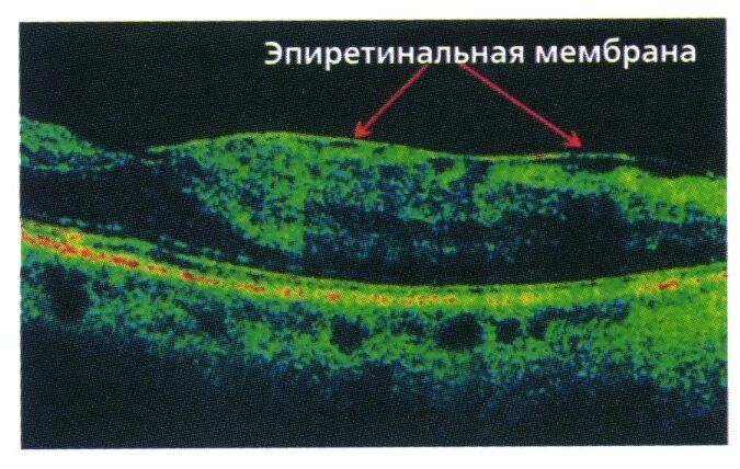 Эпиретинальный фиброз глаза. Макулярный фиброз сетчатки. Эпиретинальная мембрана сетчатки. Эпиретинальный фиброз сетчатки глаза. Эпималекулярный фиброз.