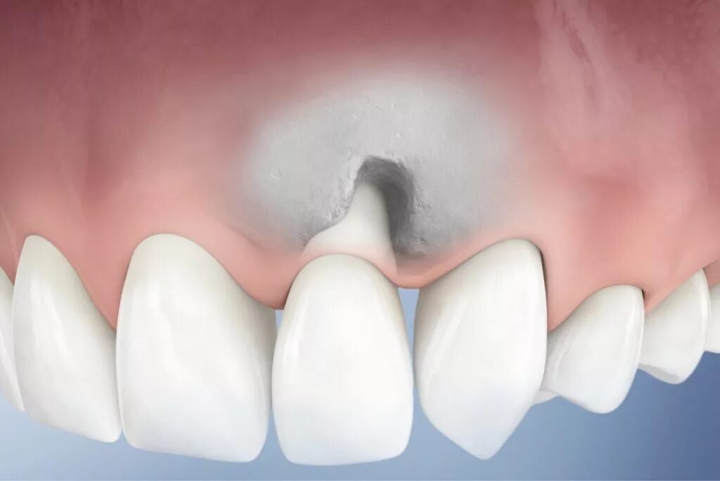 Зуб стал. Истончение эмали передних зубов. Зуб стал. Гиперестезия эмали зубов. Зуб стал.