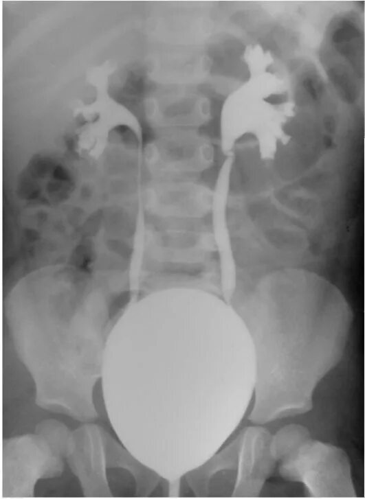 Рефлюкс 3 степени. Пузырно-мочеточниковый рефлюкс цистоуретрография. Пузырно-мочеточниковый рефлюкс микционная цистография. Микционная цистография рефлюкс. Микционная цистография ПМР.