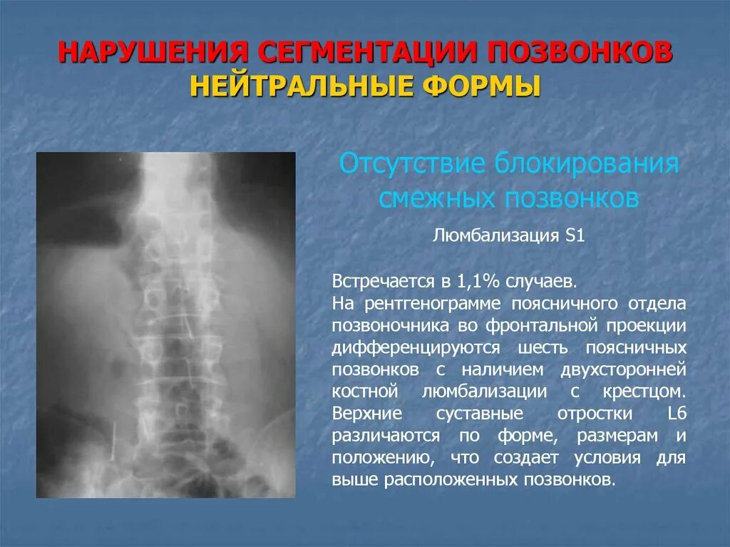 Пороки развития позвоночника. Патология развития позвонков.