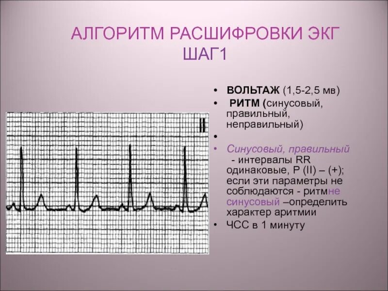 Синусовый ритм интервал pq. Показатели электрокардиограммы сердца норма. как выглядит расшифровка экг. экг мерцательная аритмия 50 мм. электрокардиограмма показатели синусовый ритм.