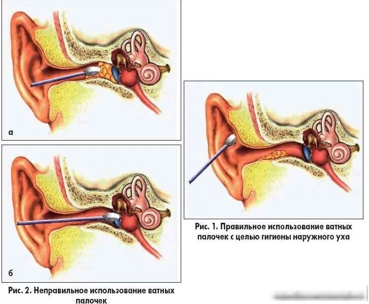 Прочистить ухо от пробки самостоятельно. Как чистить уши ватной палочкой. почему нельзя чистить уши ватными палочками. как достать пробку из уха ватной палочкой. ухо строение серная пробка.
