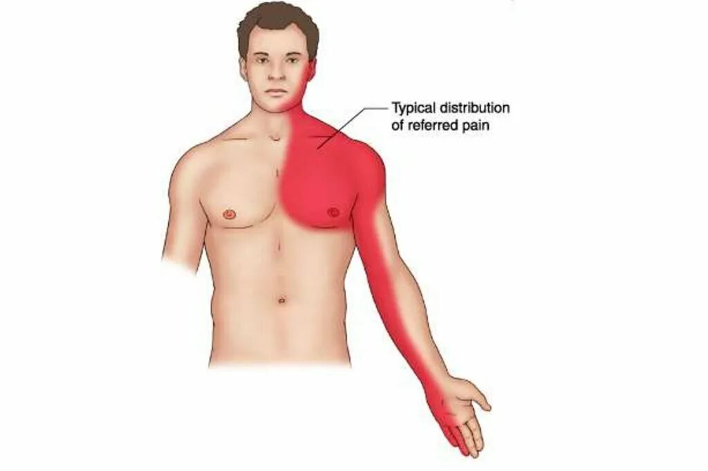 Молочной железы у мужчин симптомы. Болит Лучеое предплечье. Локализация боли при стенокардии. Боли иррадиирующие в левое плечо.