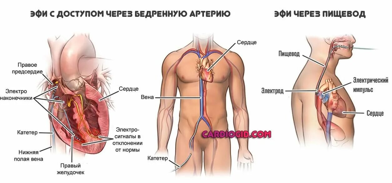 Где делают абляцию. Электрофизиологическое исследование сердца (эфи). Радиочастотная катетерная абляция (РЧА). Эфи сердца через бедренную артерию.