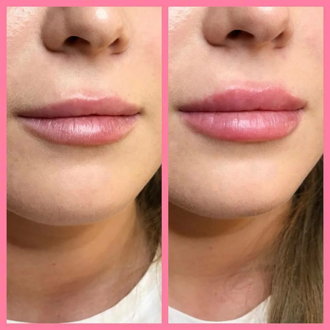 5 мл. аугментация губ отзывы. накачивание губ гиалуроновой кислотой 1 мл. филлеры для губ препараты. дермалакс для увеличения губ 1 мл.