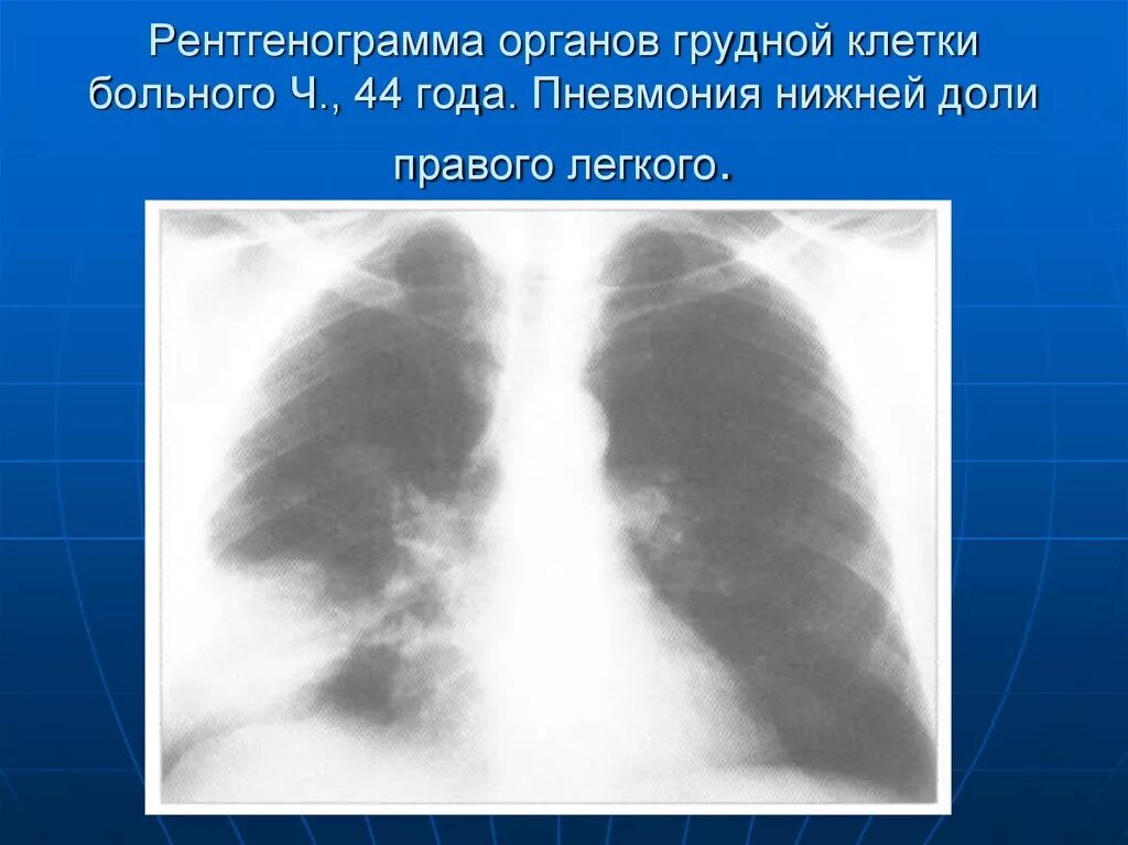 Пневмония в правой нижней доле. Правосторонняя очаговая пневмония рентген. Рентгенография грудной клетки пневмония нижнедолевая. Двухсторонняя очаговая пневмония рентген. Правосторонняя нижнедолевая очаговая пневмония рентген.