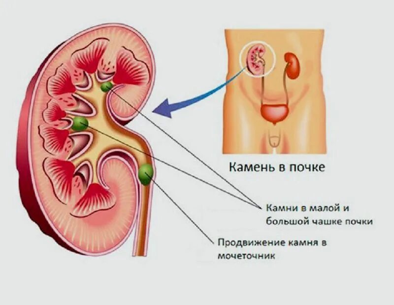 Продуло почки