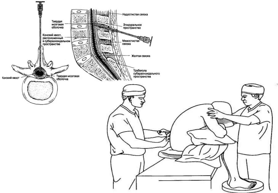 Положение больного при спинномозговой анестезии. Спинально эпидуральная анестезия техника проведения. Спинальная анестезия алгоритм выполнения. Положение пациента при эпидуральной анестезии.