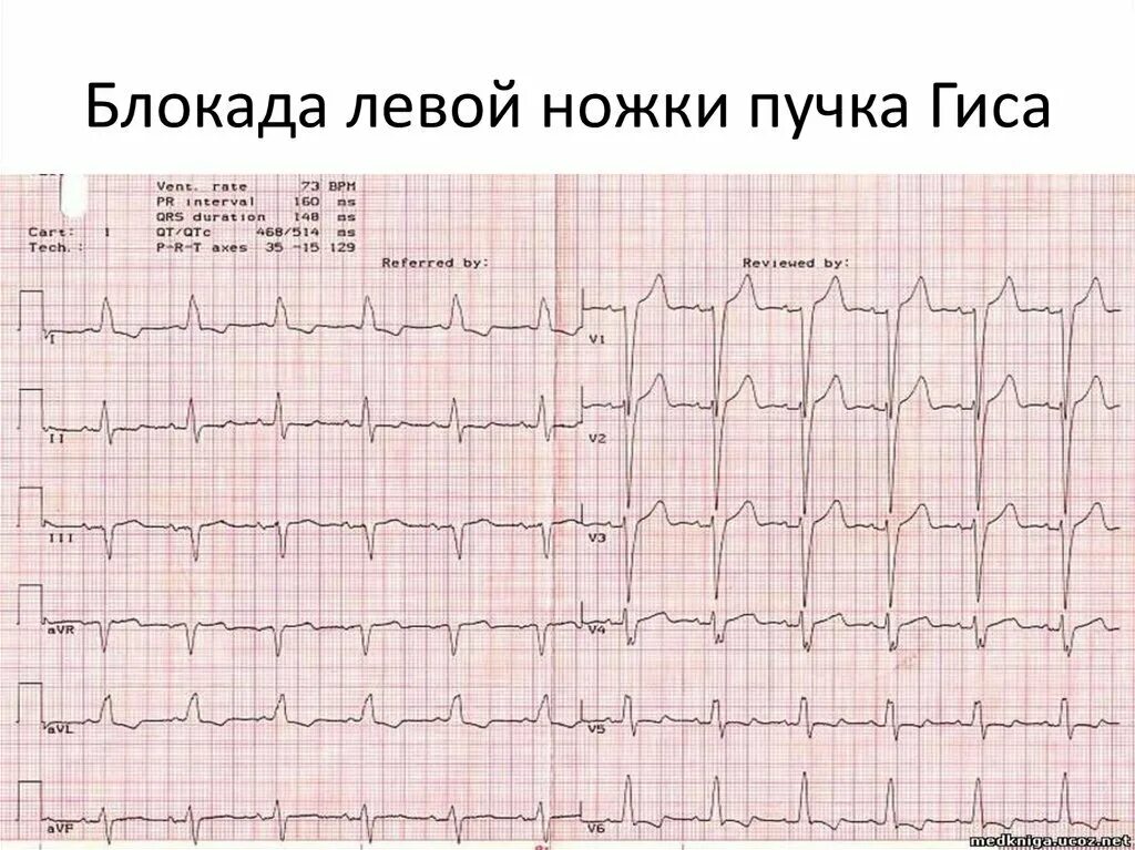 Блокада передне верхнего разветвления пучка гиса. Блокада левой ножки пучка гиса на экг. блокада левой и правой ножек пучка гиса на экг. блокады ножек пучка гиса на экг расшифровка. экг признаки полной блокады левой ножки пучка гиса на экг.