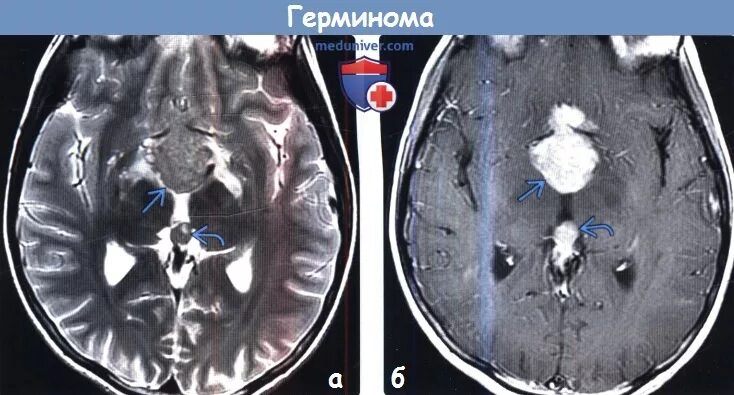 Герминома шишковидной железы кт. Герминома головного мозга мрт. Герминома воронки гипофиза мрт. Герминома