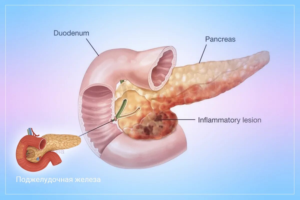 Первые признаки поджелудочной у мужчин. Поджелудочная железа человека. Панкреатит симптомы панкреатин.