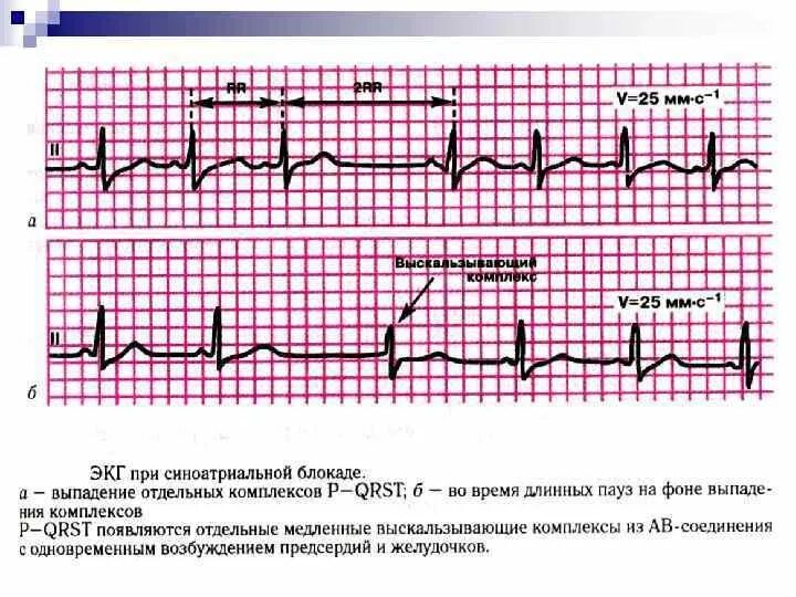 Блокада сердца это опасно. Са блокада 2 степени на ЭКГ. Са блокада 3 степени на ЭКГ. Синоатриальная блокада 3 степени на ЭКГ. Синоатриальная блокада 2 степени на ЭКГ.