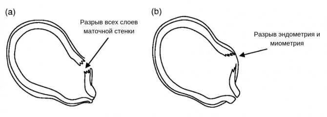 Полный и неполный разрыв матки. Начавшийся разрыв матки. Механический разрыв матки.