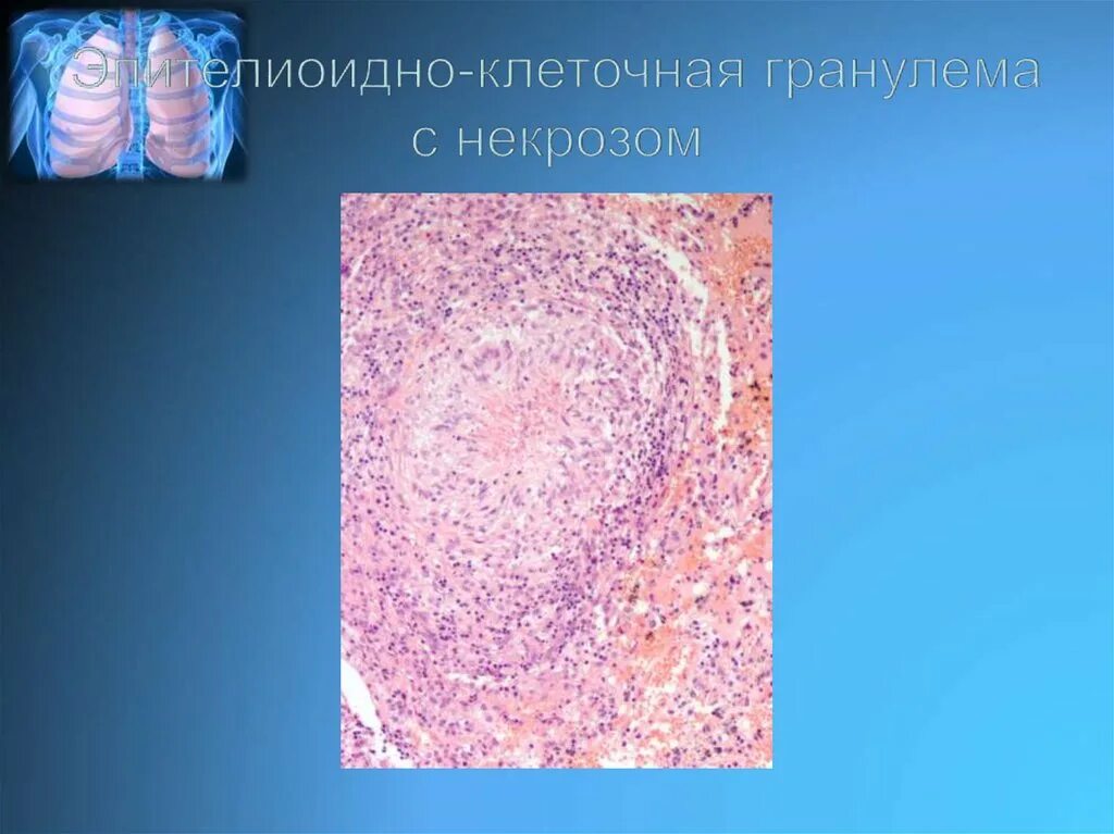 Строение туберкулезной гранулемы. Клеточная гранулема. Эпителиоидные клетки гранулемы. Сифилитическая гранулема микроскопия. Клеточная гранулема.