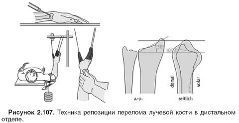Ручная репозиция перелома