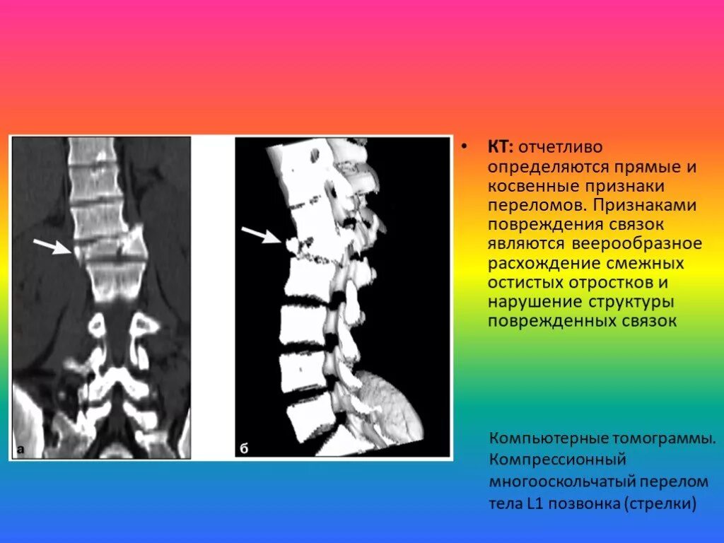 Повреждения позвоночника переломы. Лучевая диагностика повреждений позвоночника. Перелом позвоночника кт. Перелом остистого отростка кт.