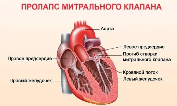 Пмк 1 степени что это такое. Пролапс передней створки митрального клапана степени. пролапс митрального клапана 1 степени. нейтральный клапан сердца. пропакс мистральрооо клапана.