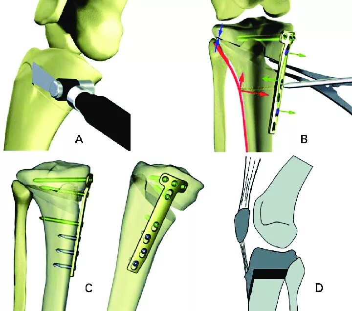 Остеотомия большеберцовой кости. Корригирующая остеотомия коленного. Тибиальная остеотомия.